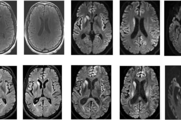 Creutzfeldt-Jakob Disease