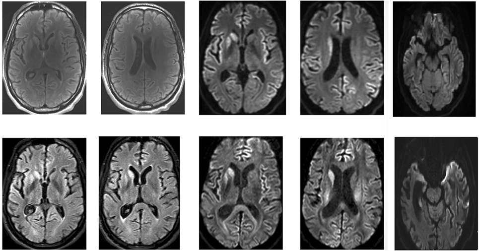 Creutzfeldt-Jakob Disease