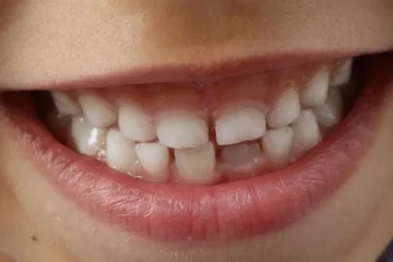 Tooth Decay