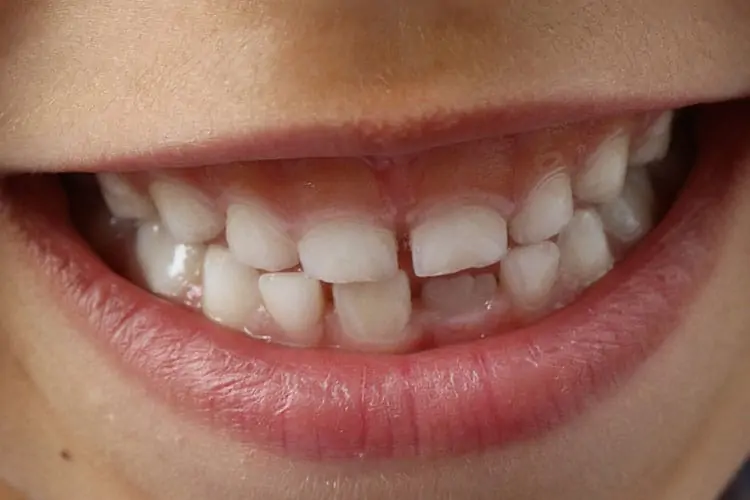 Tooth Decay