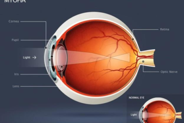 Myopia Progression in Children
