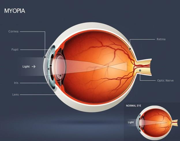 Myopia Progression in Children